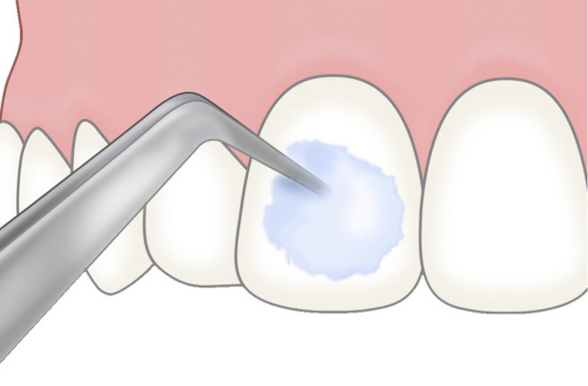フッ素塗布を行っている画像